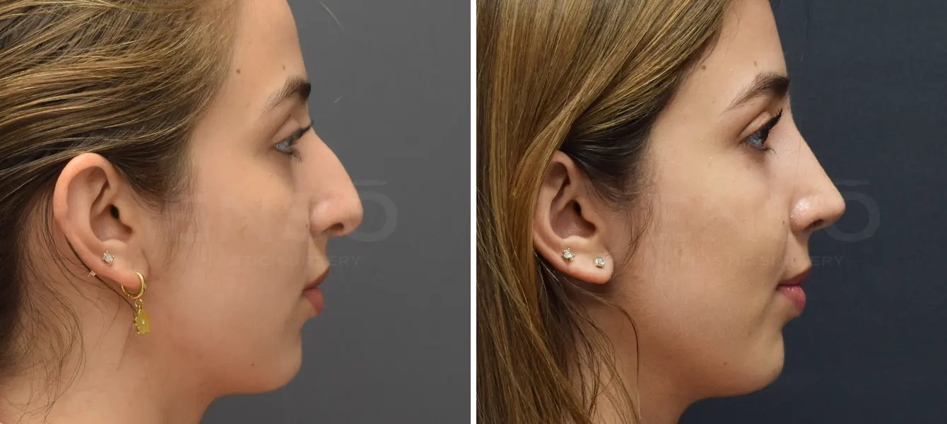 Rhinoplasty Case 3 Photo #3