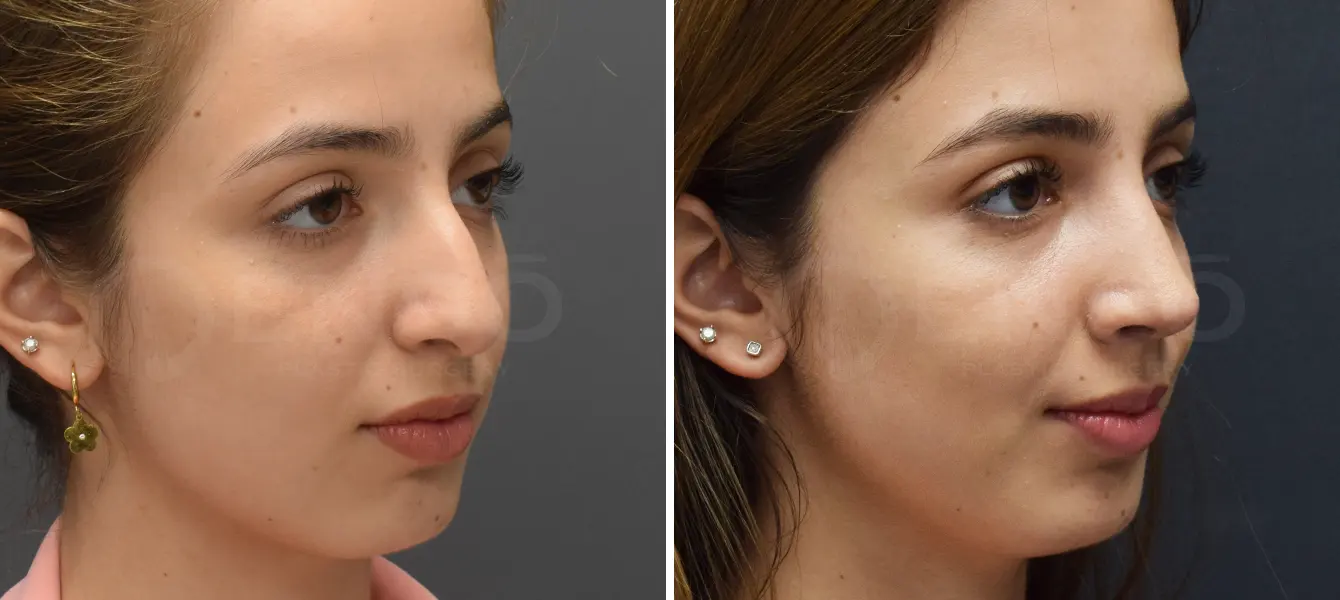 Rhinoplasty Case 3 Photo #2