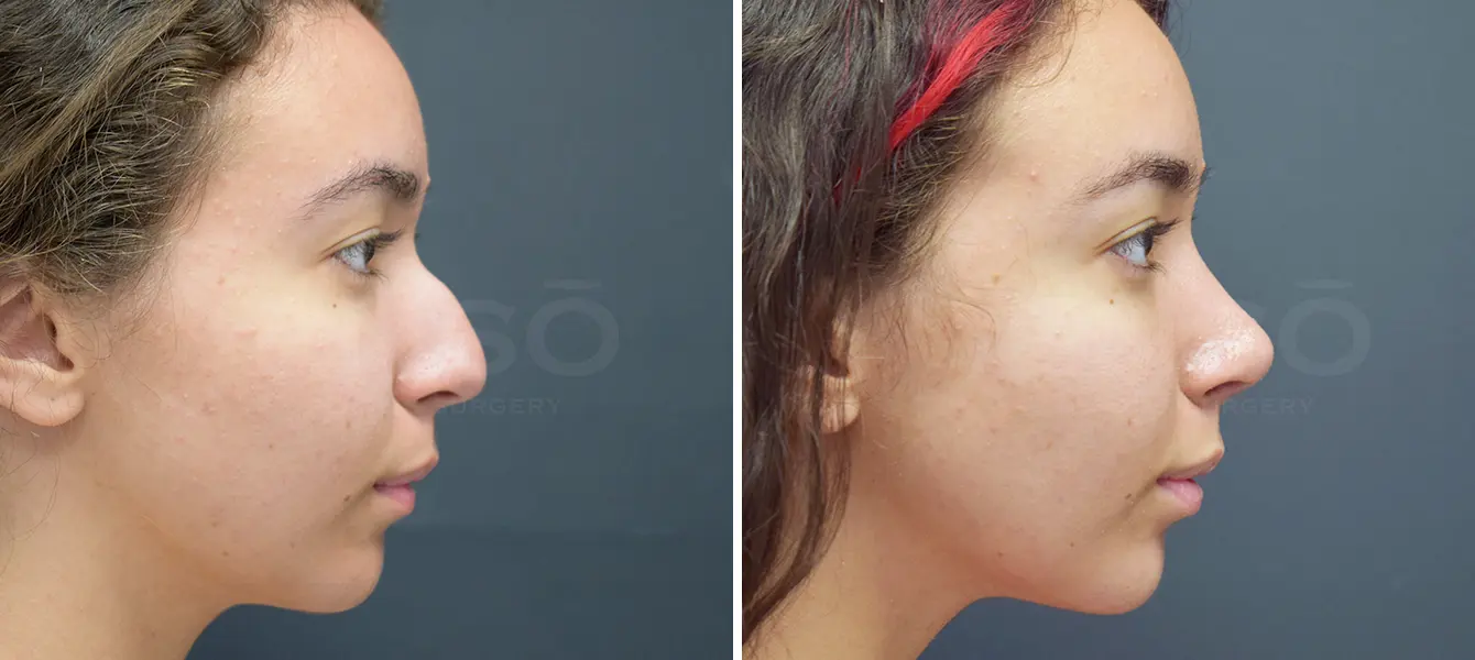 Rhinoplasty (Nose Surgery) Before & After Case #1-1