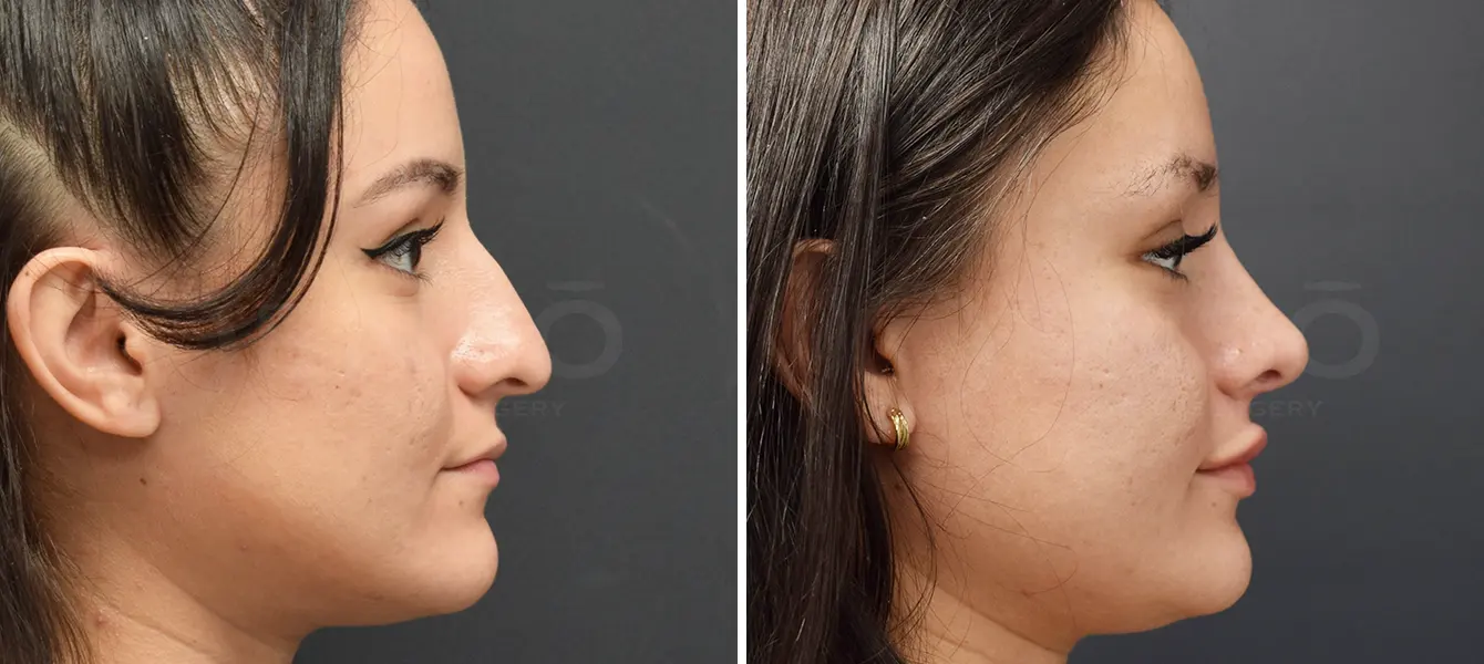 Rhinoplasty Case 12 Photo #4