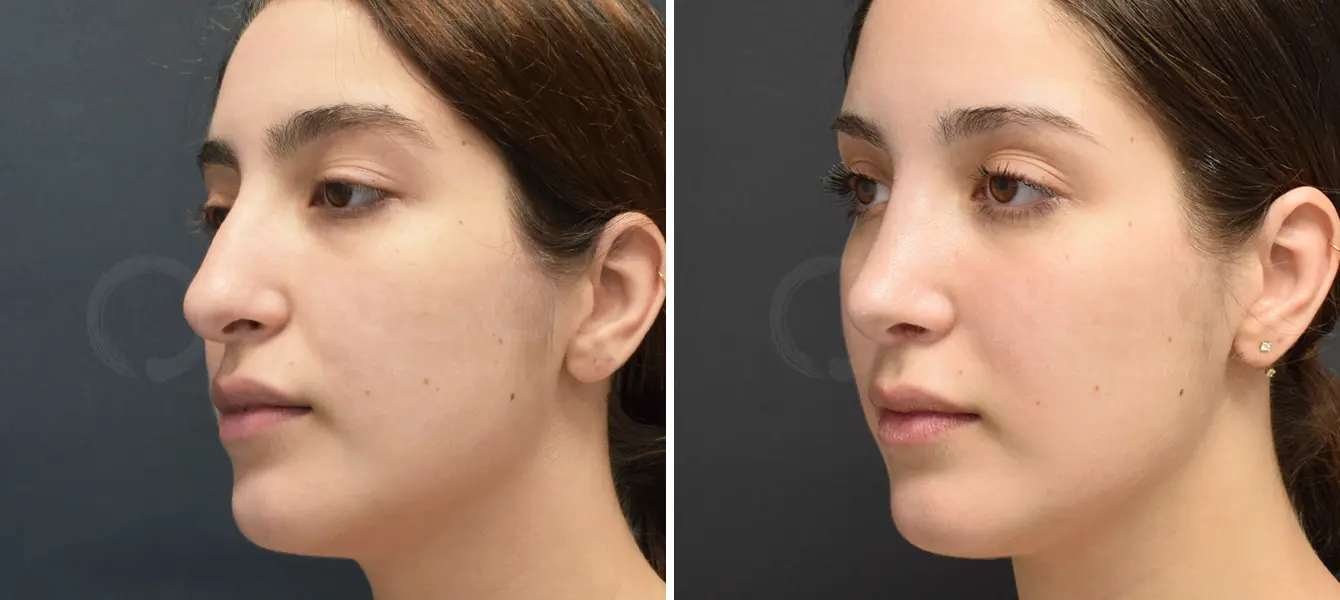 Rhinoplasty Case 2 Photo #3