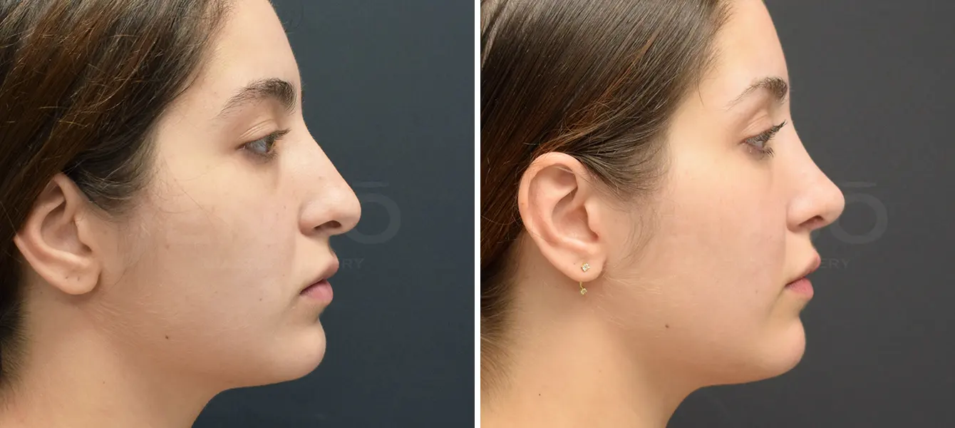 Rhinoplasty Case 2 Photo #1