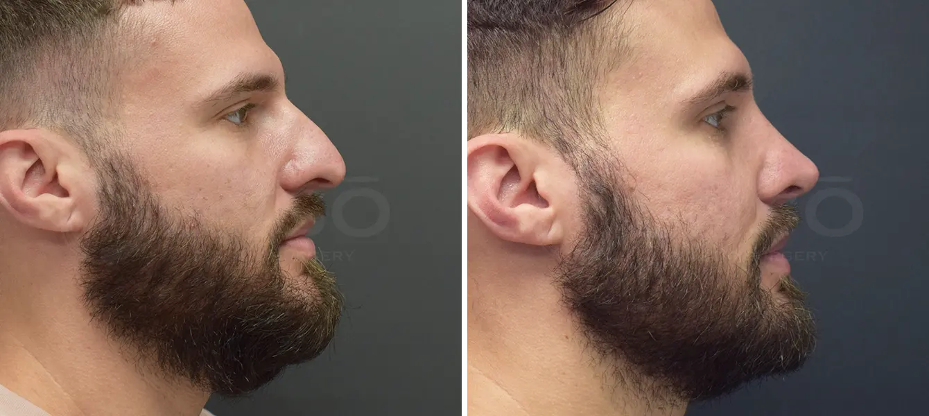 Rhinoplasty Case 6 Photo #3