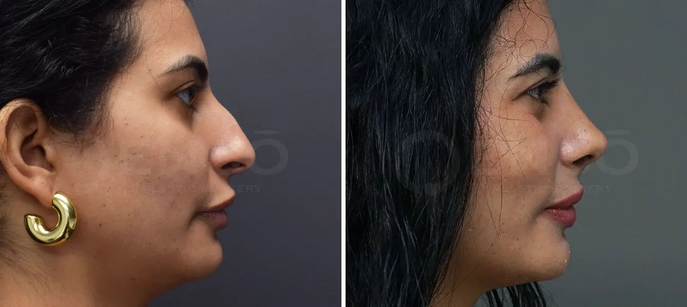 Rhinoplasty Case 5 Photo #5