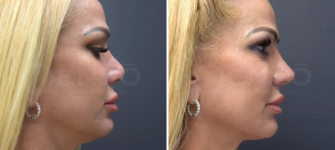 Rhinoplasty Case 4 Photo #3