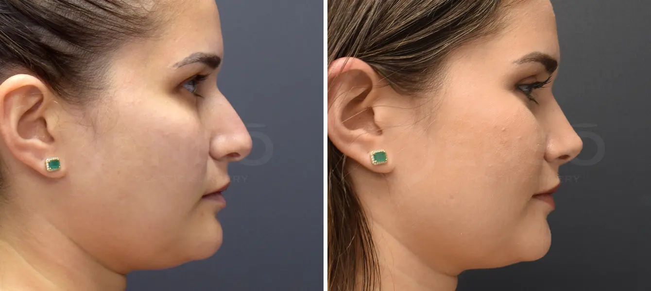 Rhinoplasty Case 7 Photo #3