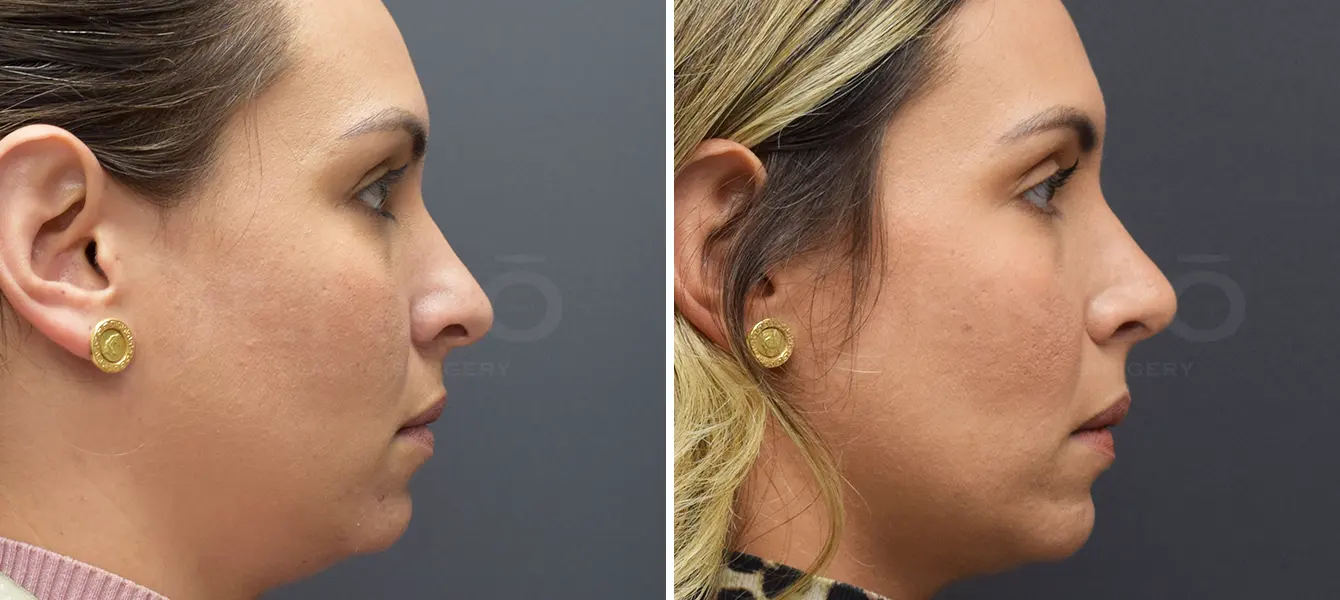 Rhinoplasty Case 8 Photo #3