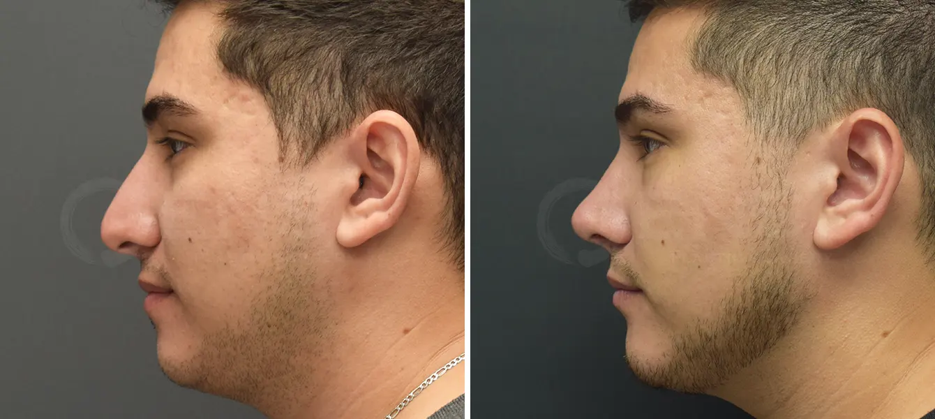 Rhinoplasty + Chin Imnplant Before & After Case #1-1