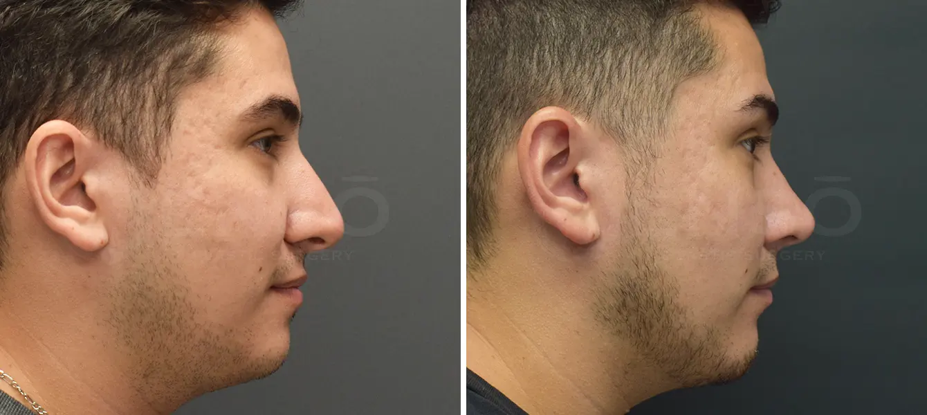 Rhinoplasty + Chin Imnplant Before & After Case #1-3 Rhinoplasty + Chin Imnplant Before & After Case #1-3