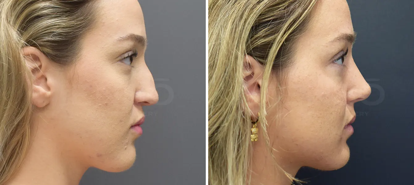 Rhinoplasty Case 9 Photo #3