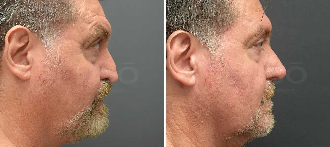 Revision Rhinoplasty Case 1 Photo #3