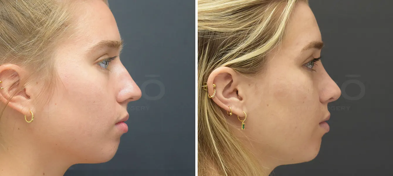 Rhinoplasty Case 13 Photo #1