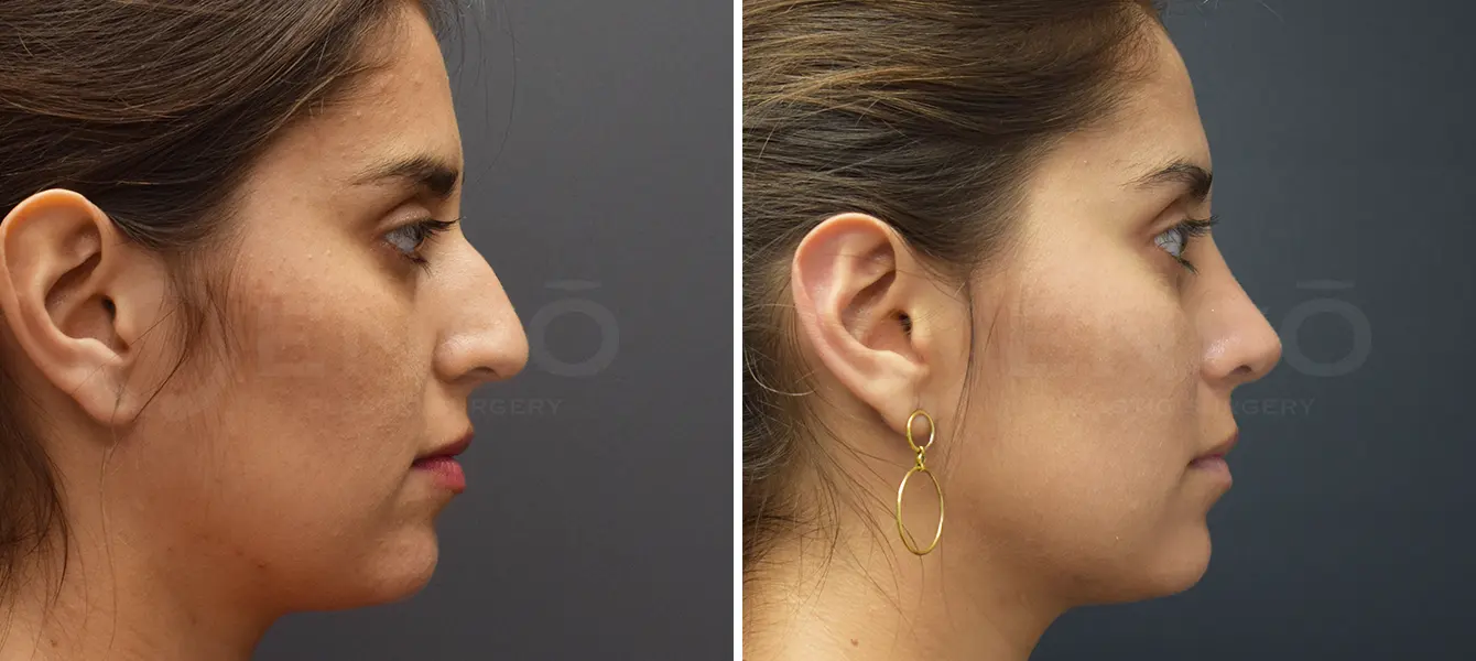 Rhinoplasty + Otoplasty Before & After Case #1-3 Rhinoplasty + Otoplasty Before & After Case #1-3