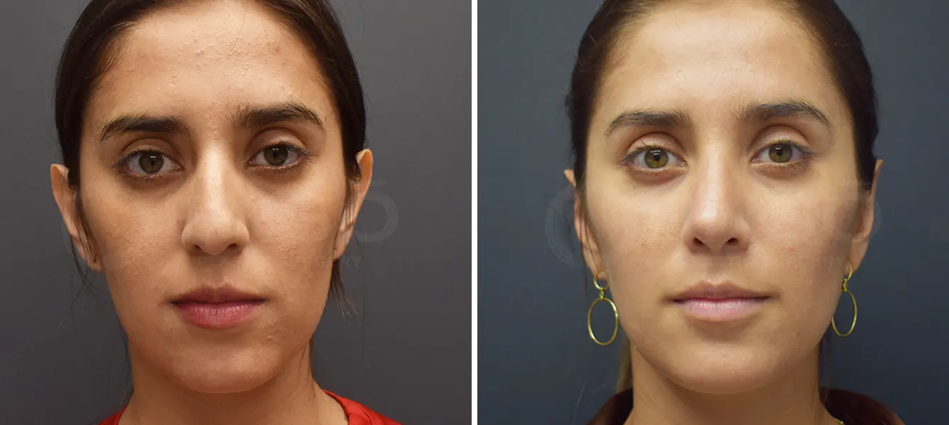 Rhinoplasty + Otoplasty Before & After Case #1-3