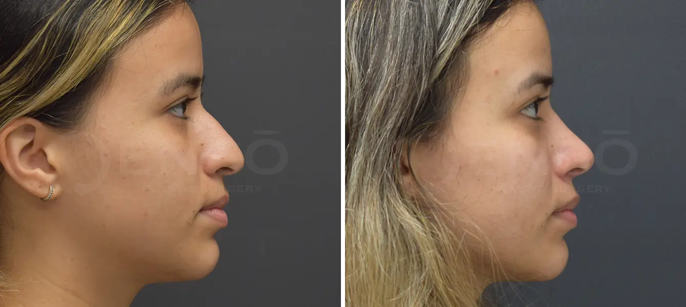Rhinoplasty Case 10 Photo #4