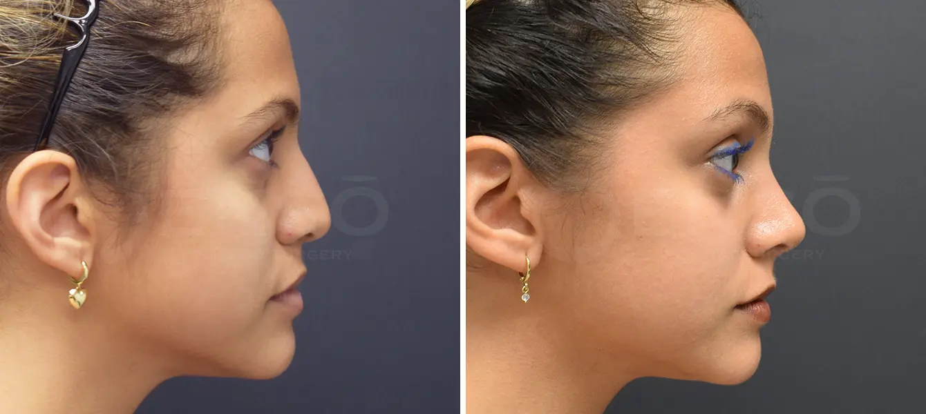 Rhinoplasty Case 17 Photo #3