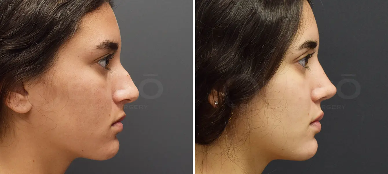 Rhinoplasty Case 11 Photo #3