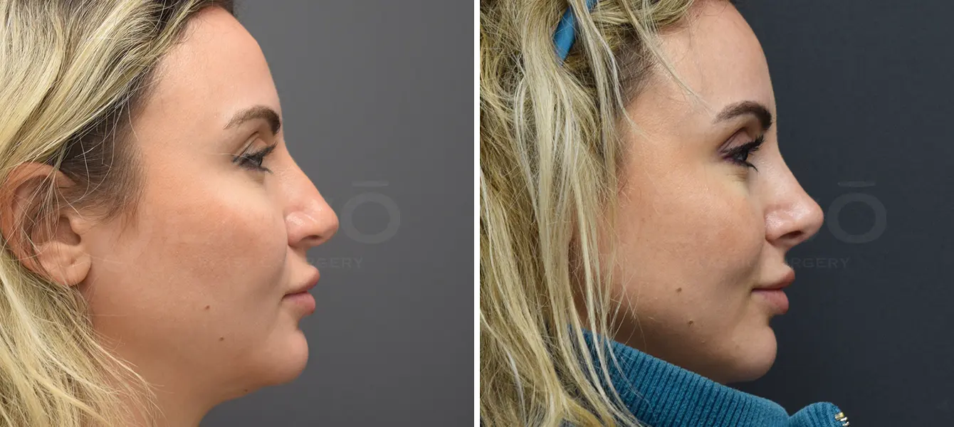 Rhinoplasty Case 18 Photo #1