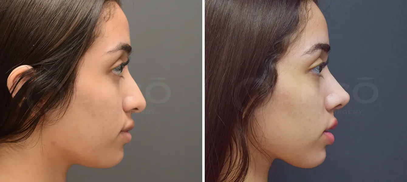 Rhinoplasty Case 16 Photo #2