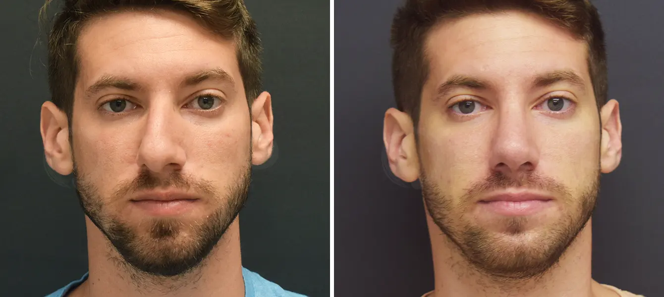 Rhinoplasty Case 15 Photo #5