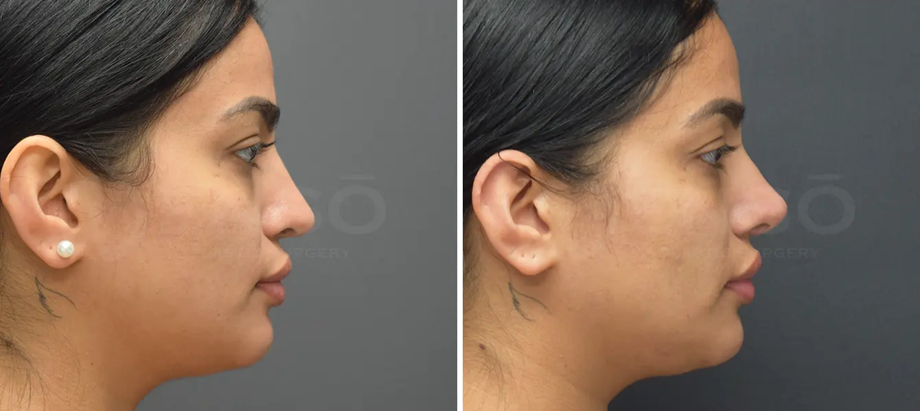 Revision Rhinoplasty Case 2 Photo #3