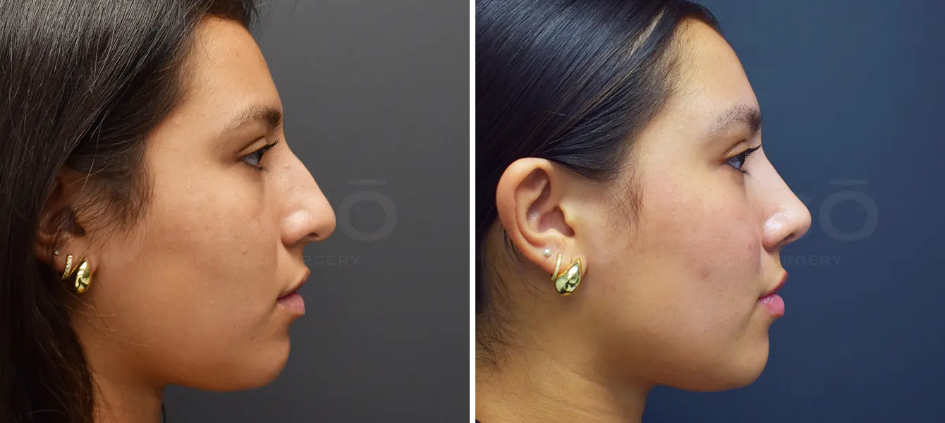 Rhinoplasty Case 19 Photo #2