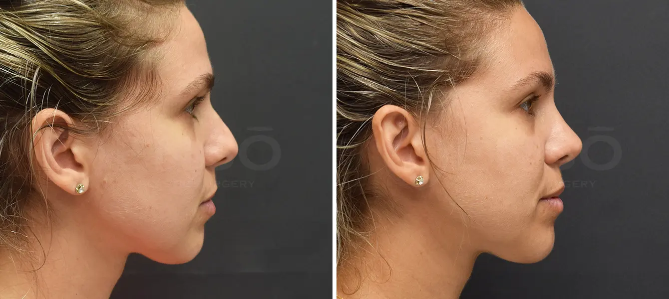 Rhinoplasty Case 21 Photo #3