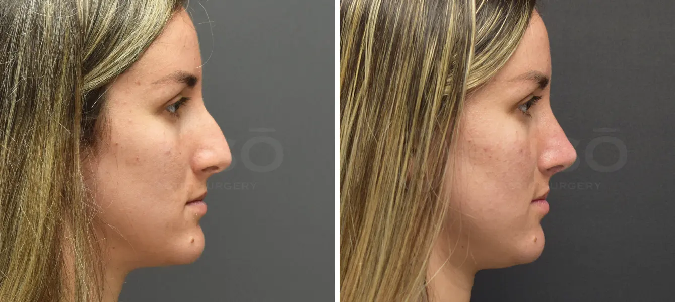 Rhinoplasty Case 20 Photo #3