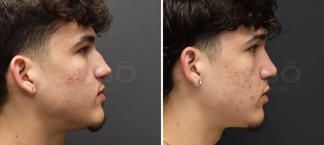 Rhinoplasty Case 14 Photo #2