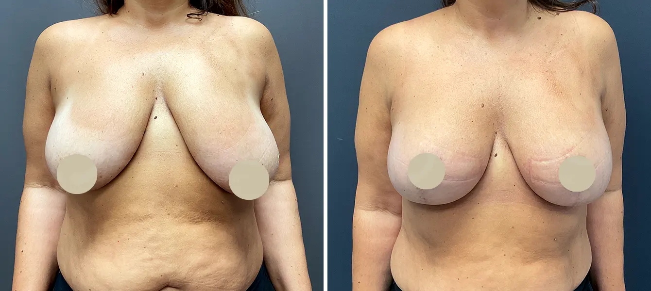 ENSO Breast Lift (Mastopexy) Before and After Case 1 image 3