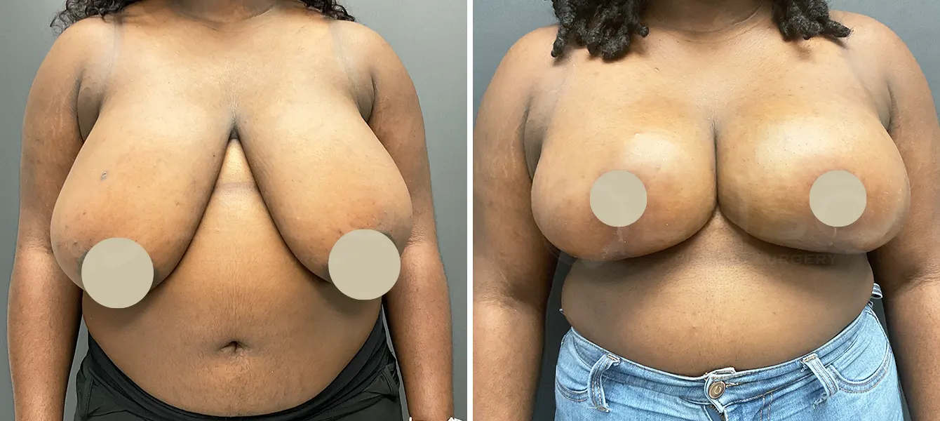 ENSO Breast Reduction Before and After Case 1 image 3