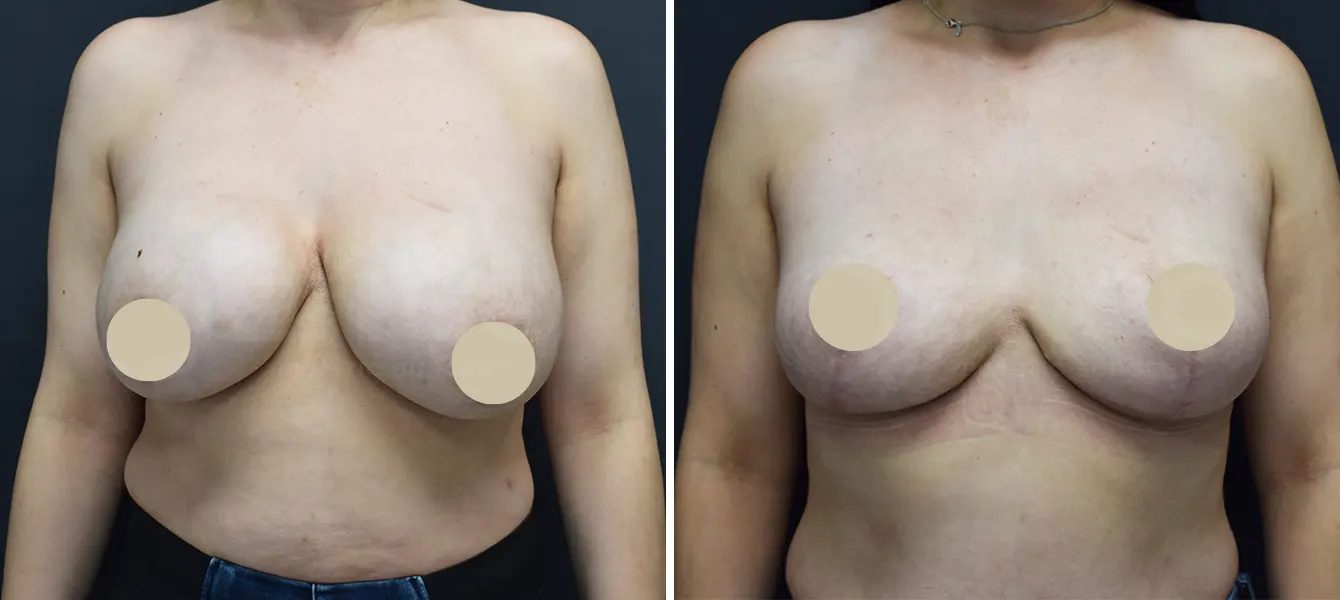 ENSO Explant with Lift Before and After Case 1 image 5