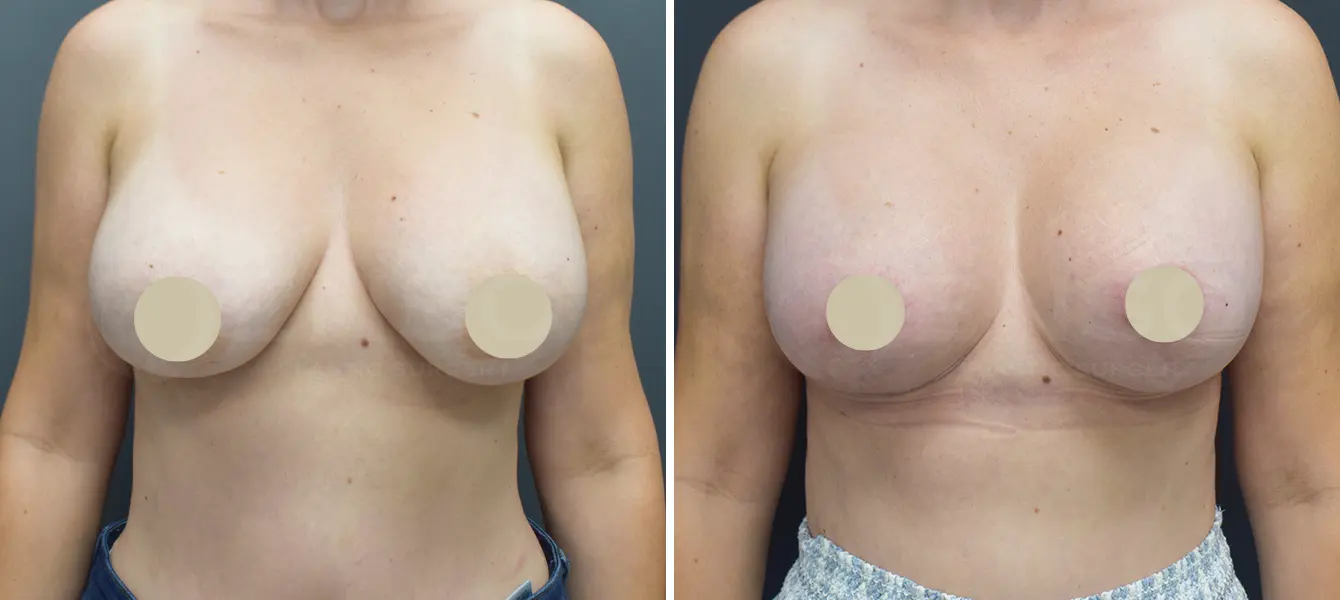 ENSO Breast Lift (Mastopexy) Before and After Case 3 image 1
