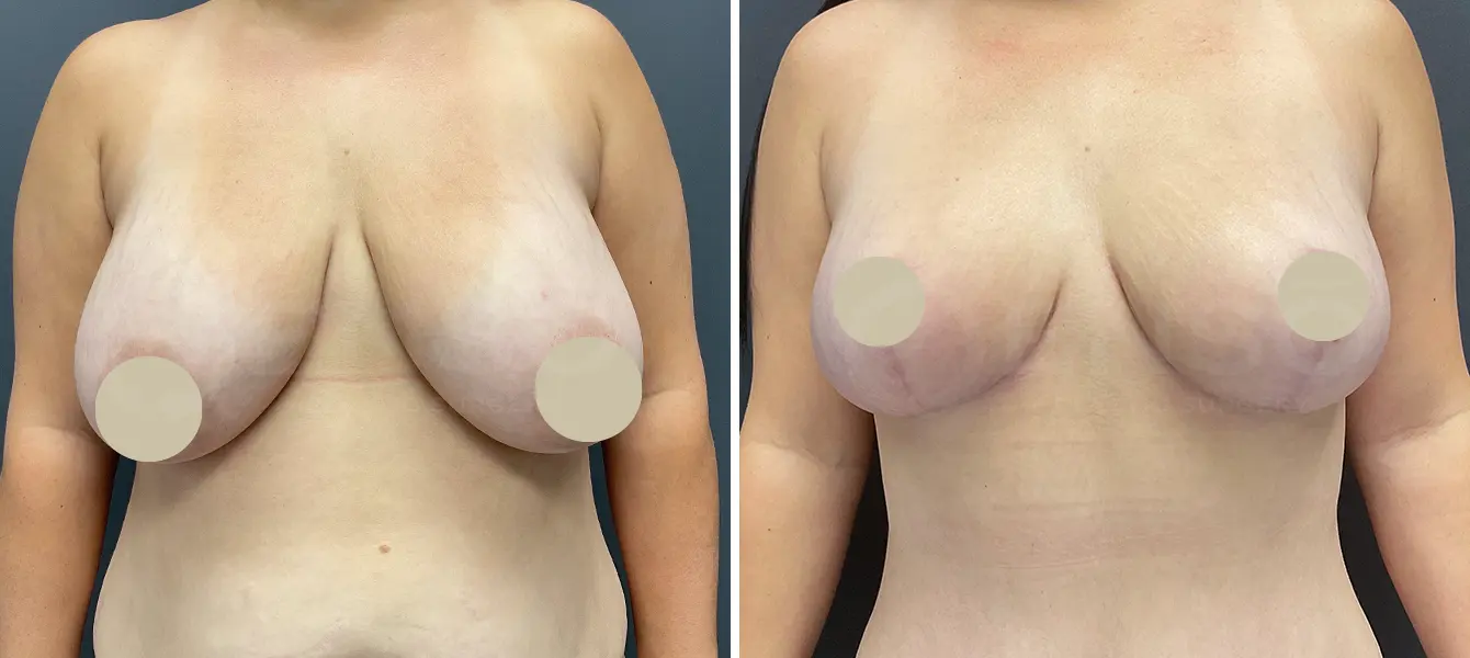 ENSO Breast Reduction Before and After Case 2 image 4